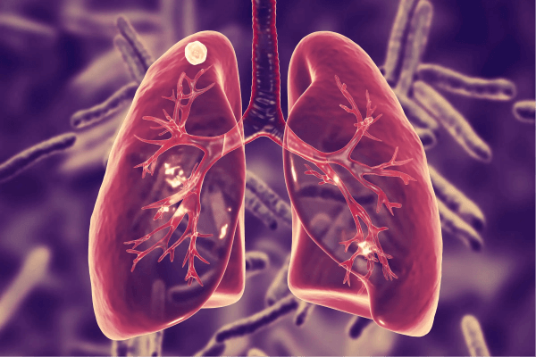 Bacterial Disease in Humans - Tuberculosis