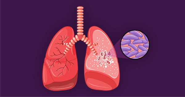 Bacterial Disease in Humans - Tuberculosis