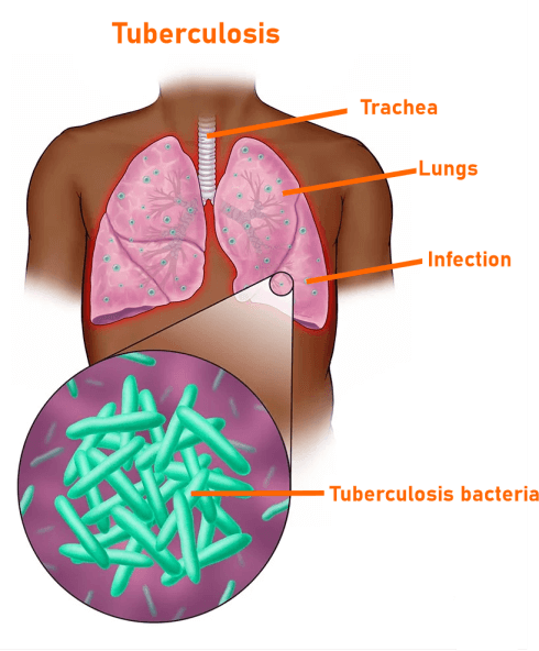 Bacterial Infection Symptoms