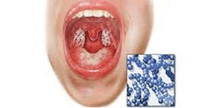 Bacterial Strep Throat