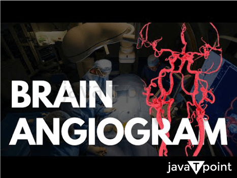 Brain Angiogram