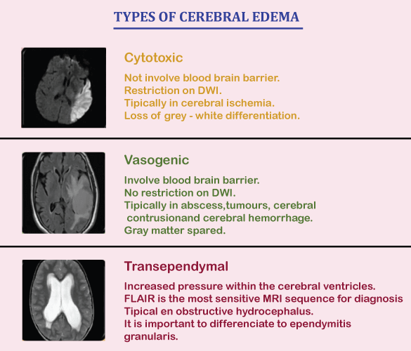 Brain (Cerebral) Edema