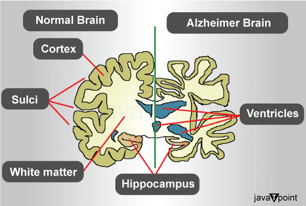 Brain Diseases