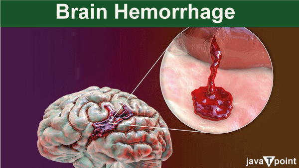 Brain Haemorrhage Symptoms