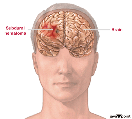 Brain Hematoma