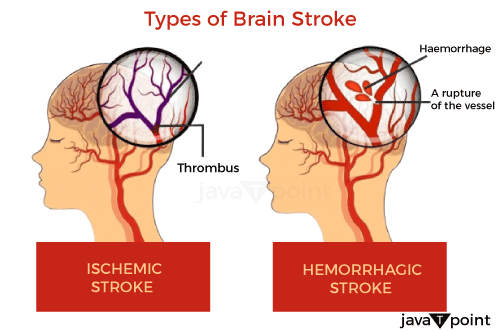 Brain Stroke Symptoms