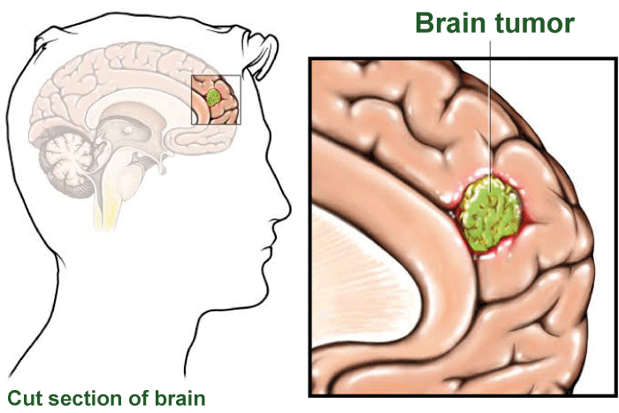 Brain Tumor Symptoms