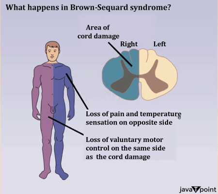 Brown Sequard Syndrome