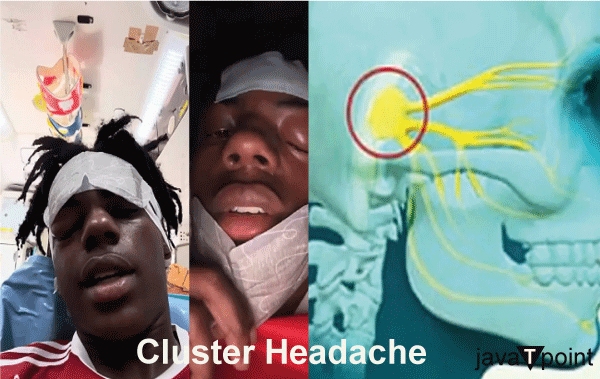 Clusters Headaches