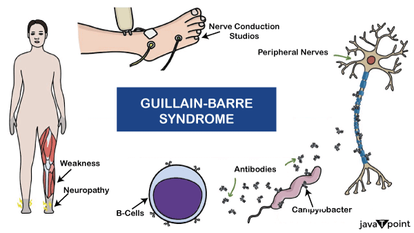 Guillain-Barré syndrome