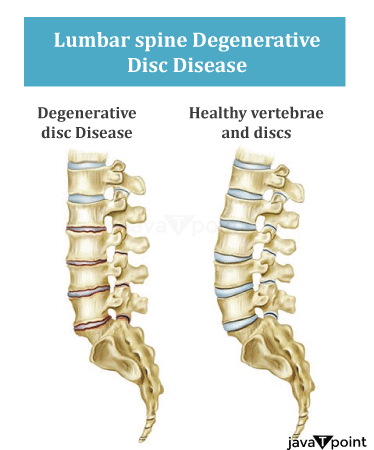 Lumbar Disk Disease