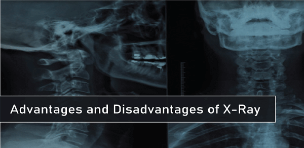 Advantages and Disadvantages of X-ray