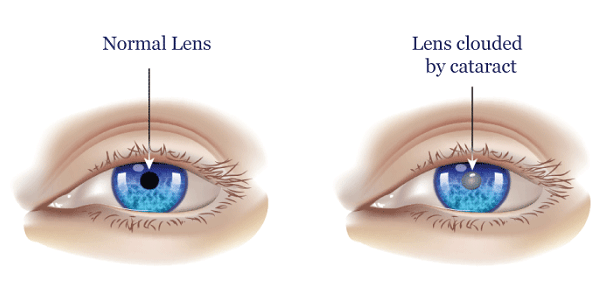 Cataract - Definition, causes, symptoms, prevention/treatment