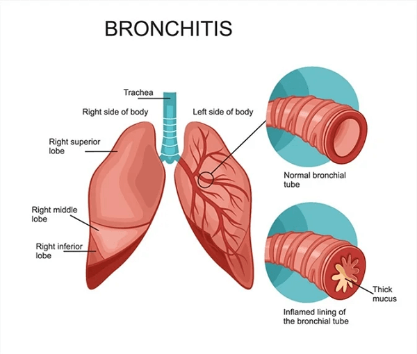 Bronchitis Definition