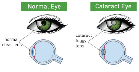 Cataracts Definition