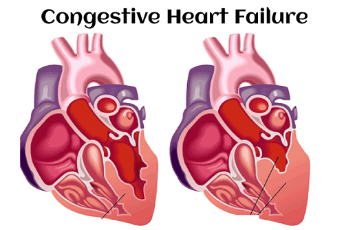 Congestive heart failure definition