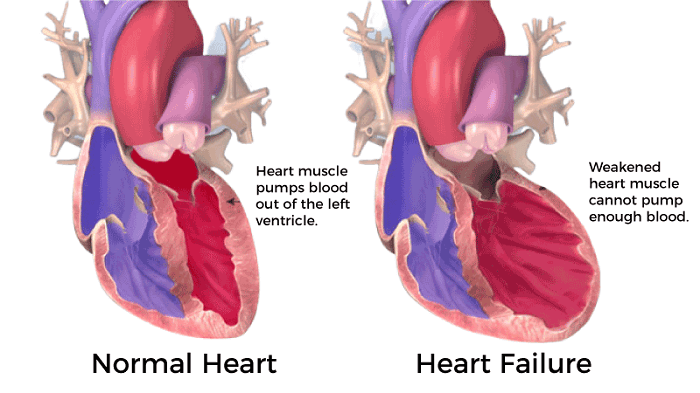 Congestive heart failure definition