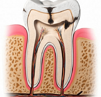 Dental Caries Definition