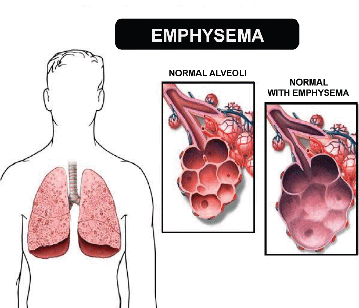 Emphysema Definition