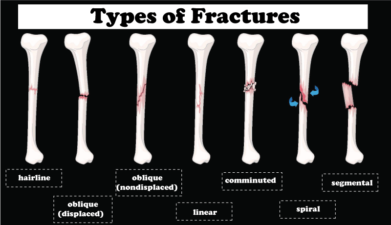 Fracture Definition JavaTpoint