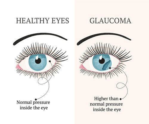Glaucoma Definition