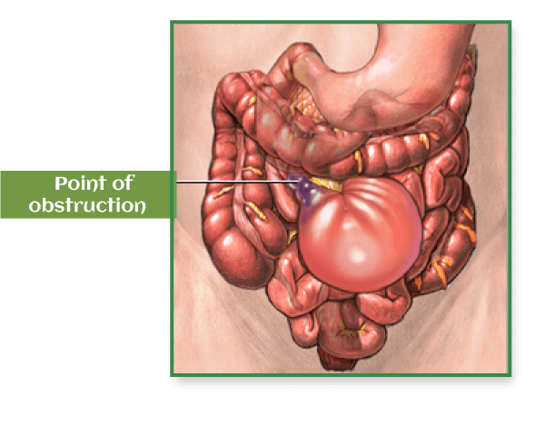 Intestinal Obstruction Definition