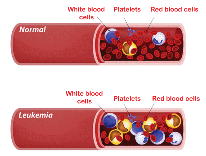 Leukemia Definition