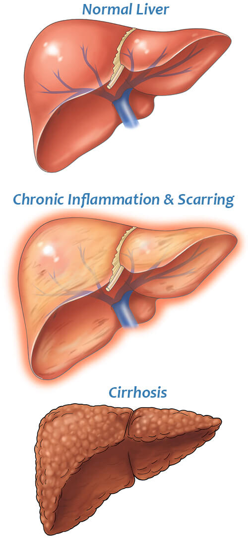 Liver Cirrhosis Definition