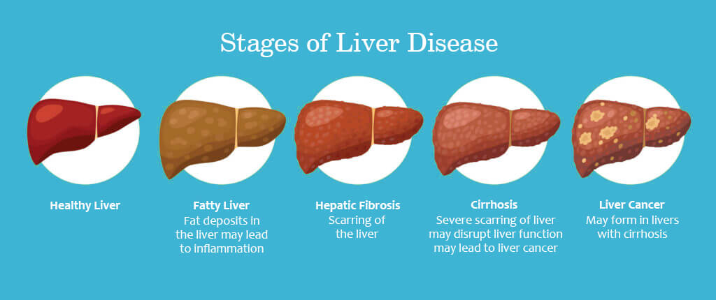 Liver Cirrhosis Definition