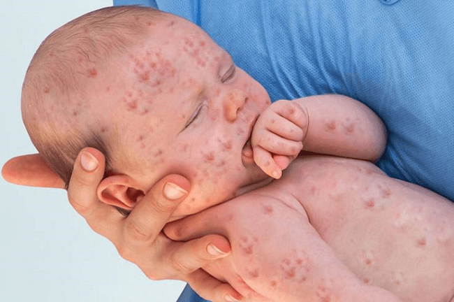 https://static.javatpoint.com/definition/images/measles-definition.png