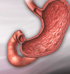 Peptic Ulcer Definition