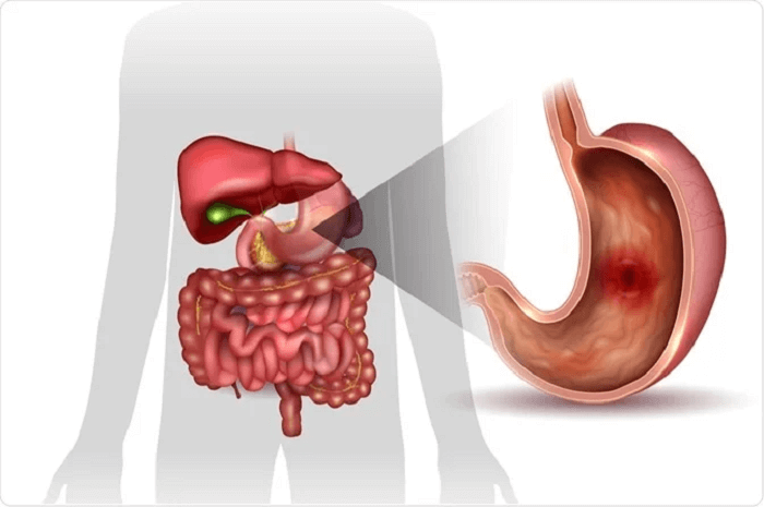 Peptic Ulcer Definition