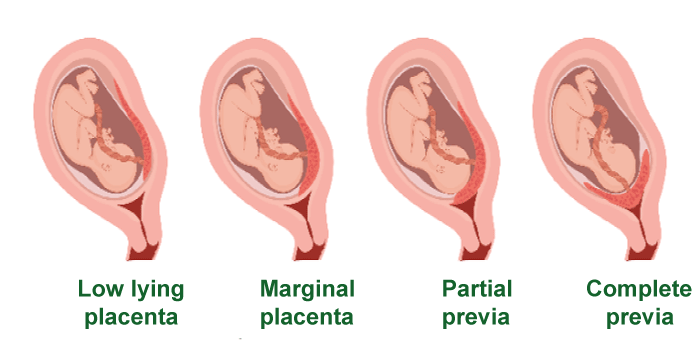 Placenta Previa Definition