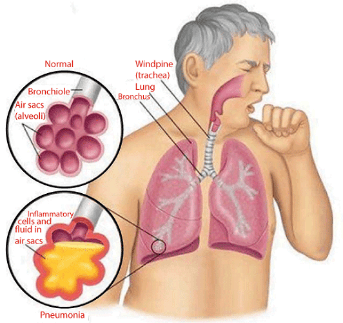 Pneumonia Definition