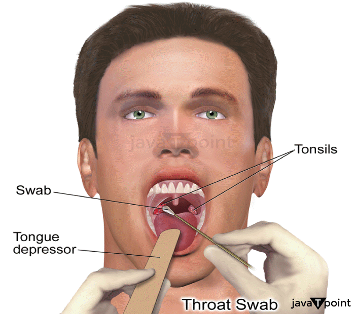 Tonsillitis  Definition