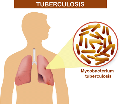 Tuberculosis Definition