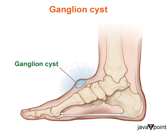 Difference Between Baker's Cyst and Ganglion Cyst - javatpoint