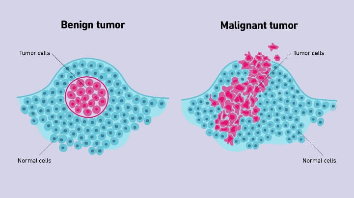 Difference Between Benign and Malignant Tumors