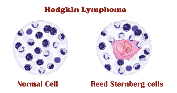 Difference between Hodgkin and Non Hodgkin Lymphoma