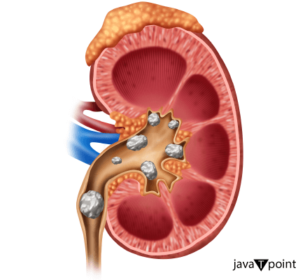 Difference Between Kidney Stone and Kidney Infection