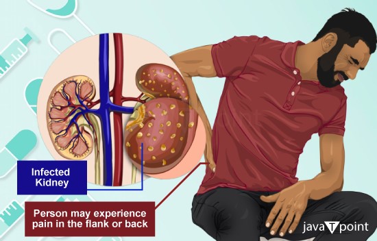 Difference Between Kidney Stone and Kidney Infection