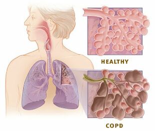 COPD Full Form in Medical