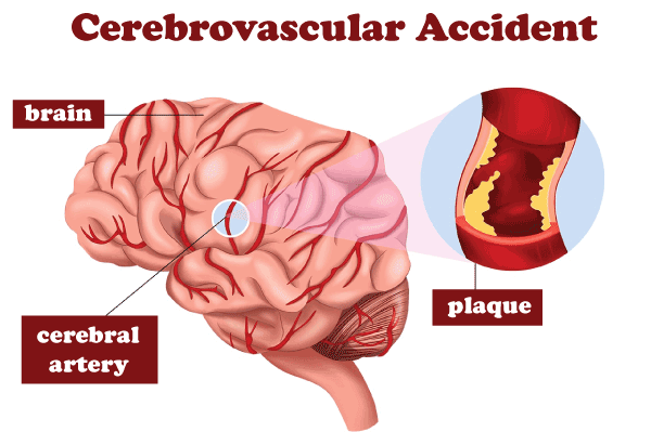 CVA Full Form in Medical: Cerebrovascular Accident - javaTpoint