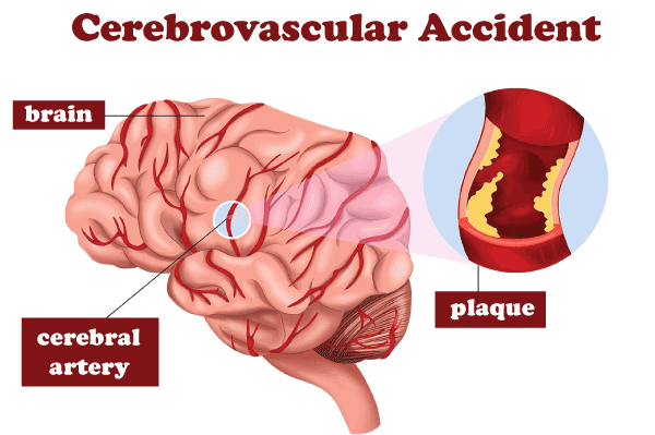 CVA Full Form In Medical Cerebrovascular Accident JavaTpoint