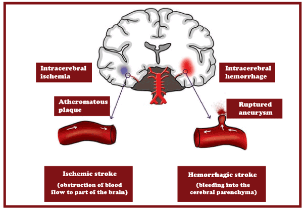 CVA Full Form In Medical Cerebrovascular Accident JavaTpoint