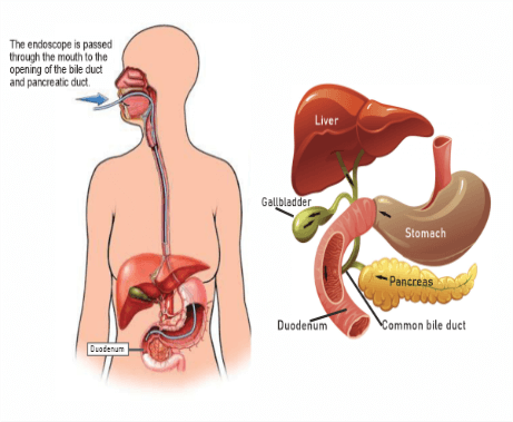 ERCP Full Form in Medical