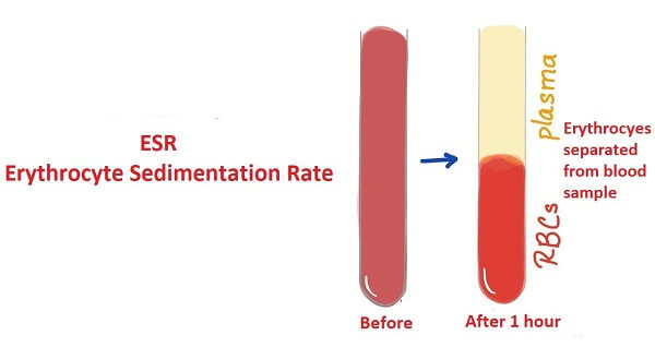 ESR Full Form Erythrocyte Sedimentation Rate JavaTpoint