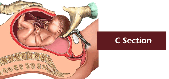 C-section Video  Medical Video Library