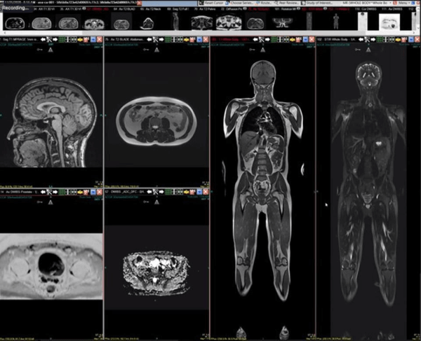 MRI Full Form in Medical