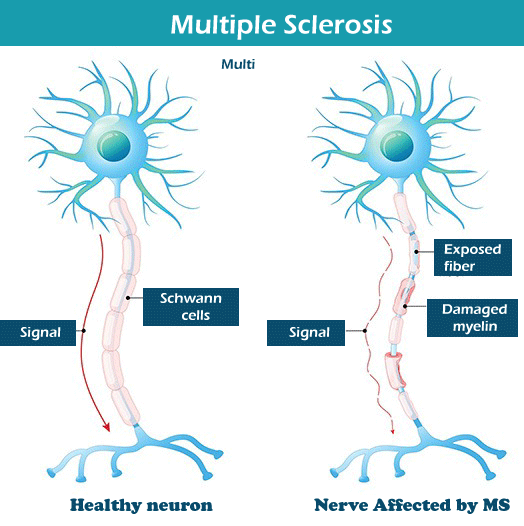 MS Full Form In Medical Multiple Sclerosis JavaTpoint